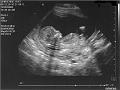 ultrasound122806